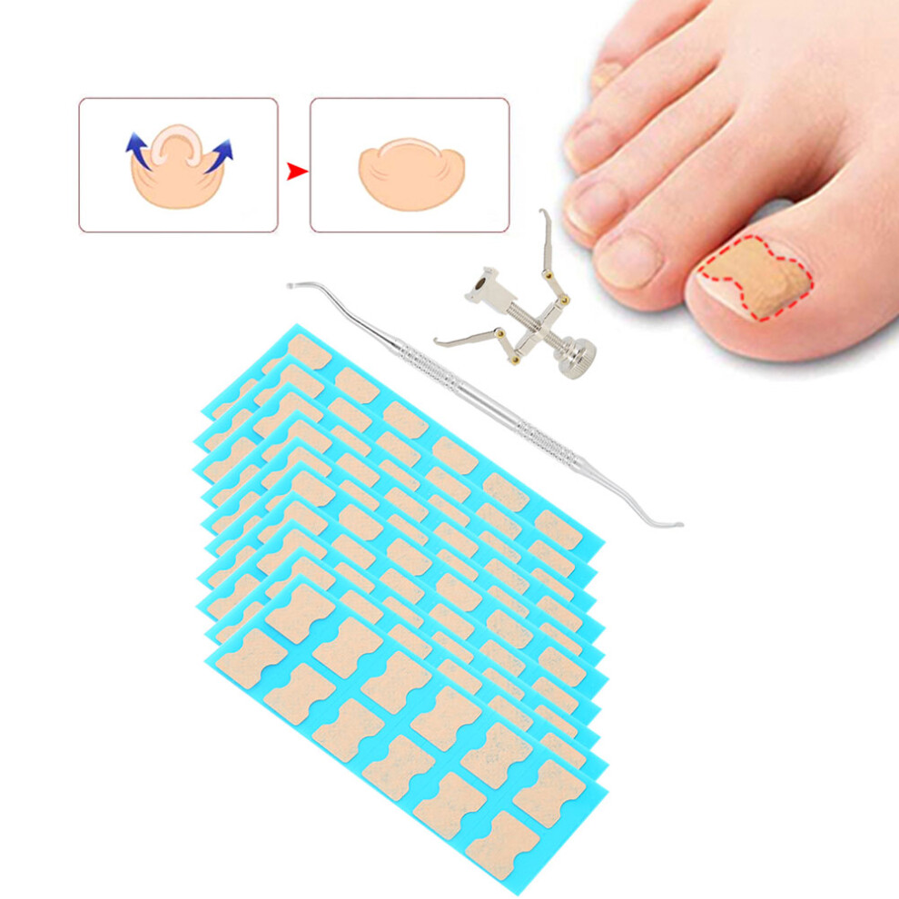 Ingrown Toenail Correction Patch 120pcs, Elastic PVD & Steel Pedicure Tool-image-OPC-PMZSG2Q-NEW