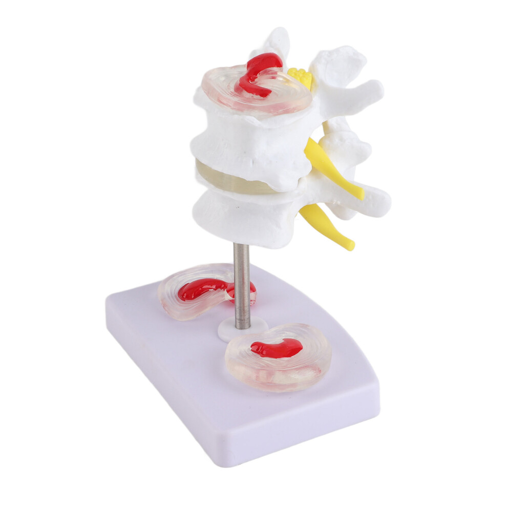 Medical Anatomy Spine Model with Herniation Detail for Educational Use