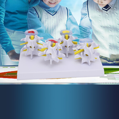 4-Stage Human Lumbar Vertebrae Model — Normal & Pathological, PVC 2