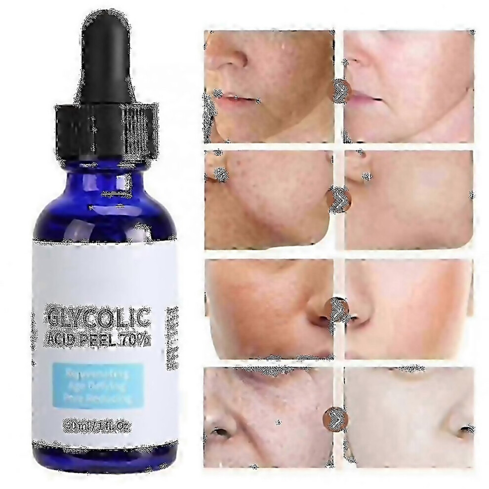 For Glycolic Acid Peel 70 Purity 5 Concentration Skin Repair Pore Minimizing Brightening Acne Treatm