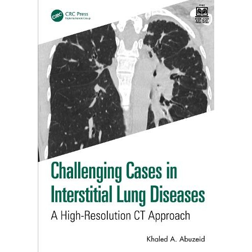Challenging Cases in Interstitial Lung Diseases by Khaled A. Abuzeid P