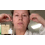 Unsichtbare Gesichtsstraffungs-Patches: V-Lift & Straffung 7