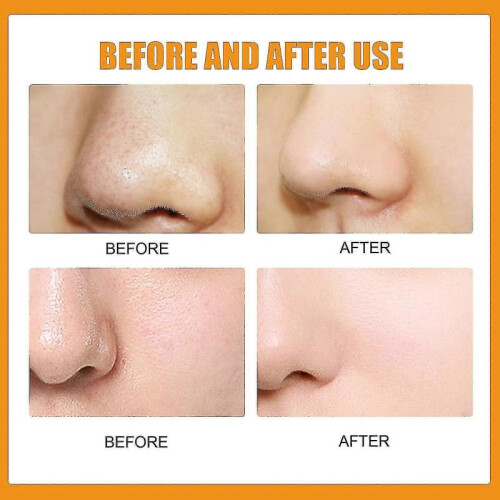 (Black) Cleansing Facial Blackhead Removal Nasal Patch 2