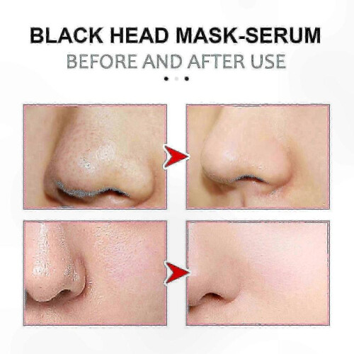 Blackhead Removal Strips for Nose, Deep Cleansing and Smooth Skin Solution 2