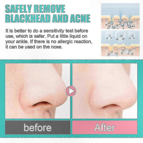 Blackhead Removal Strips for Nose, Deep Cleansing and Smooth Skin Solution 1