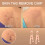 12Pcs Copper Skin Tag Remover Clips Wart Tag Extractor Copper Tag Out 2