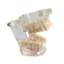 Dental model teeth implant restoration bridge teaching study tooth medicine disease dentist dental products