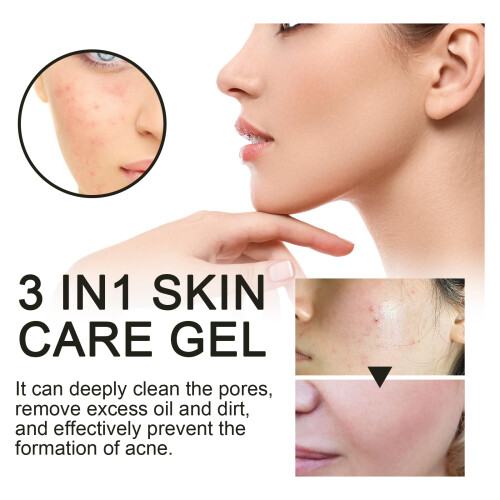 3-in-1 Acne Gel: Deep Cleanse, Fade Marks, Moisturize 2