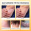 Bienen-Gift Psoriasis Juckreiz-Spray 4