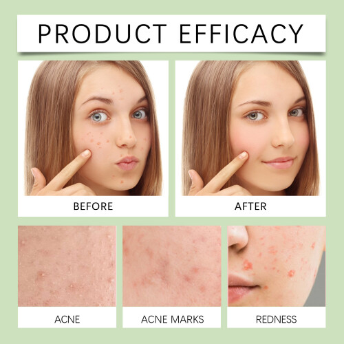 Anti-Acne Patch Gentle Blemish Relief Breathable 2