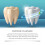 Denture Cleaning Tablets Dental Stain 4
