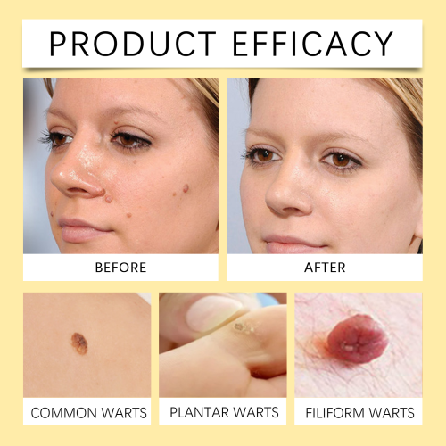 Bee Venom Wart & Mole Removal Spray 2