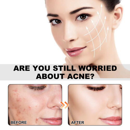 Meereslebens-Muster Akne-Patches, Aufhellend & Reparierend 2