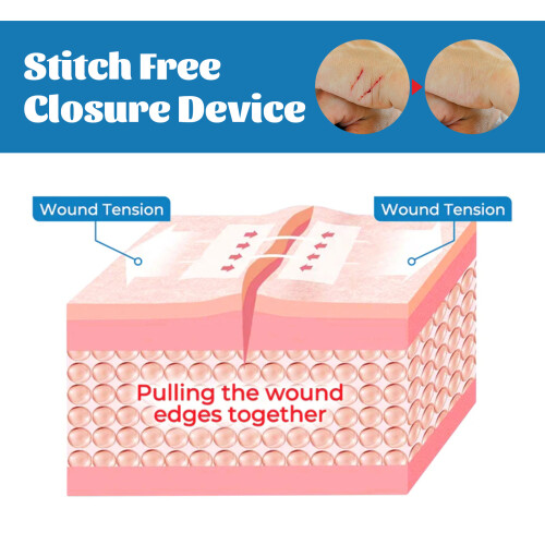 Closed Wound Care Patch - Gentle Skin Comfort 2