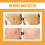 Bee Venom Wart Remover Patch 11