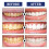 Teeth Whitening Serum, Remove Yellow Stains Deep Cleaning 15