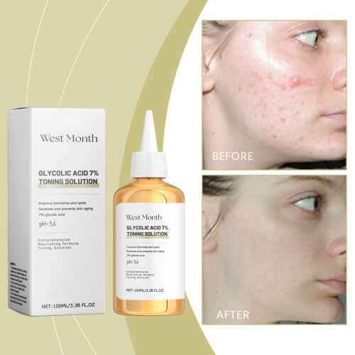 Acne Control Moisturizing Toner Gentle Hydrating 1