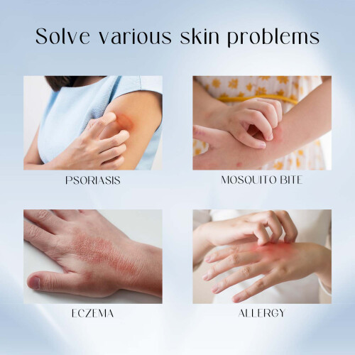 Psoriasis-Creme gegen rote, juckende Haut 2