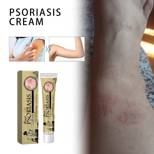 Psoriasis-Creme gegen rote, juckende Haut 1