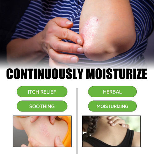 Psoriasis Cream, Relieves Itchy Skin & Redness 2