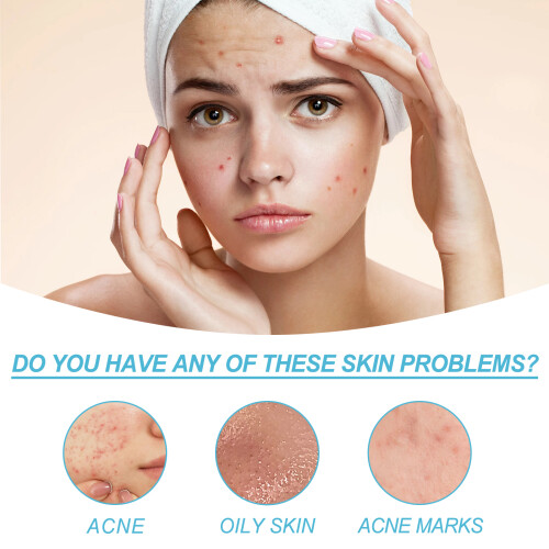 Acne Gel for Closed Pimples, Lighten Marks, Blackheads 2