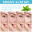 Acne Gel for Closed Pimples, Lighten Marks, Blackheads 11