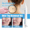 Double Head Wart & Mole Pen Set for Skin Care 11