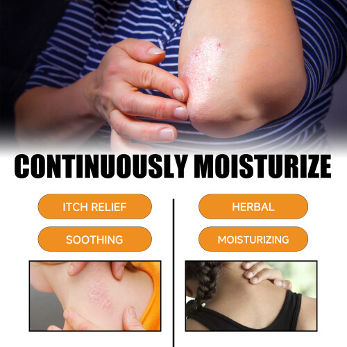 Bee Venom Psoriasis Spray for Soothing Skin Irritation 2