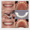 Soft Silicone Denture Teeth Veneers Temporary Teeth 4