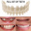 Upper Lower Dental Veneers Dentures - Snap On False Teeth For A Perfect Smile 1