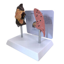 Modèle anatomique de poumon de fumeur et de poumon sain pour