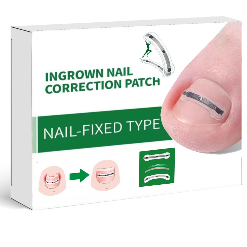 Ingrown Toenail Corrector Titanium Alloy UltraThin 0.3mm Curved Toenail Straightener for Pain Relief