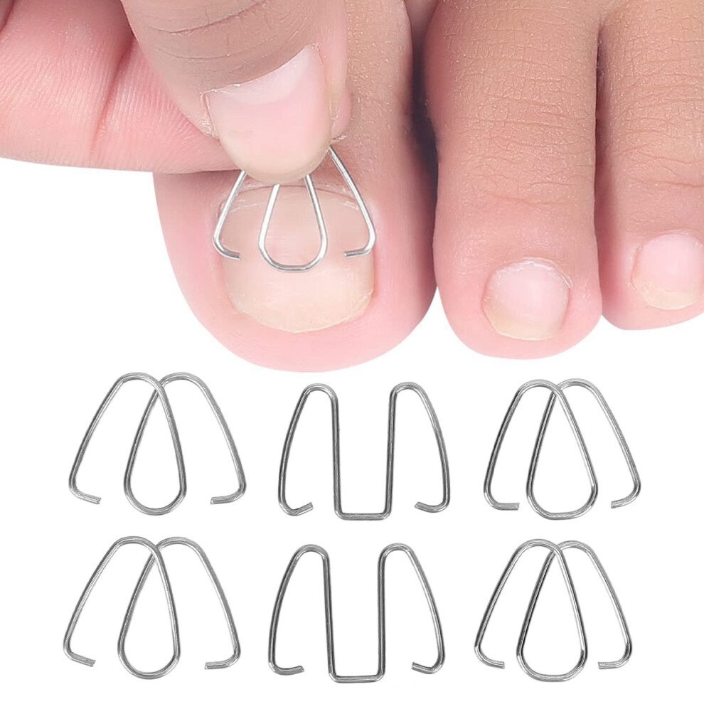 Ingrown Toenail Corrector Brace with Adjustable Fit for Gentle Nail Straightening and Pain Relief