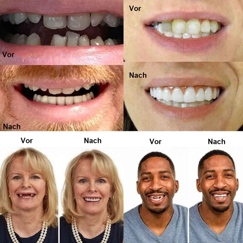 Σετ Flex Teeth σε φωτεινό λευκό χρώμα, άνω και κάτω, με φυσική απόχρωση -