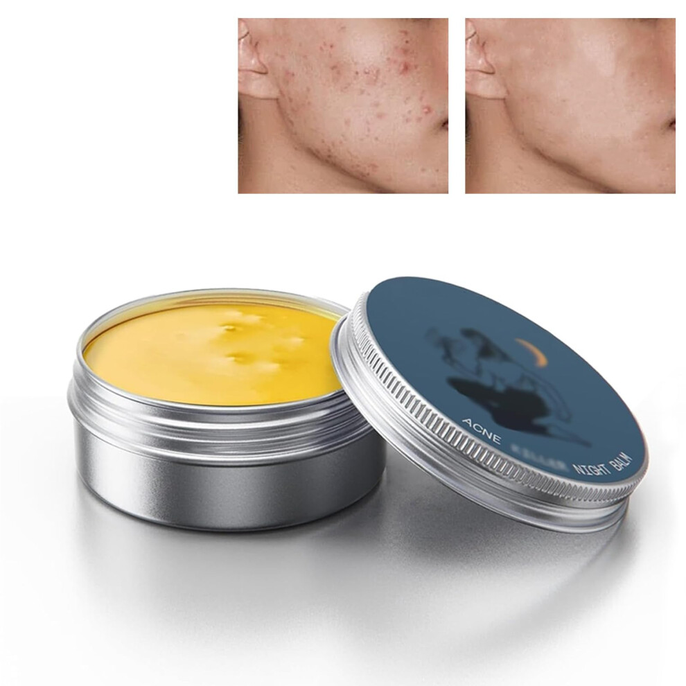 Cream Natural Acne Treatment For Men With Deep Pore Cleansing And Oil Control Acne For Sensitive Skin