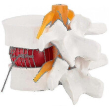 Human Anatomy Model for Demonstrating Lumbar Disc Herniation of the Lumbar Spine
