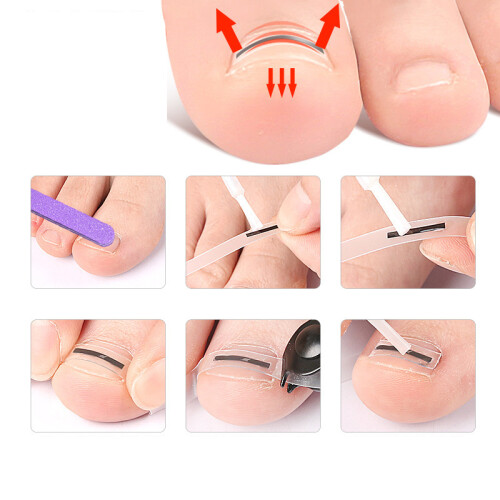 10-Pack Toenail Correction Patches for Ingrown Nails – Thin, Flexible Silver Design  16 mm 2