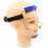 Inverted Jaw Facial Chin Correction 3