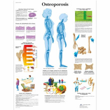 Osteoporosis Awareness Poster Printed on Paper, 1 Laminated Educational Chart, 24x36 Inches