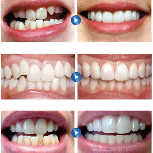 Veneers Fake Teeth  and Bottom Set for Instant Smile Makeover Covers Missing Teeth 1