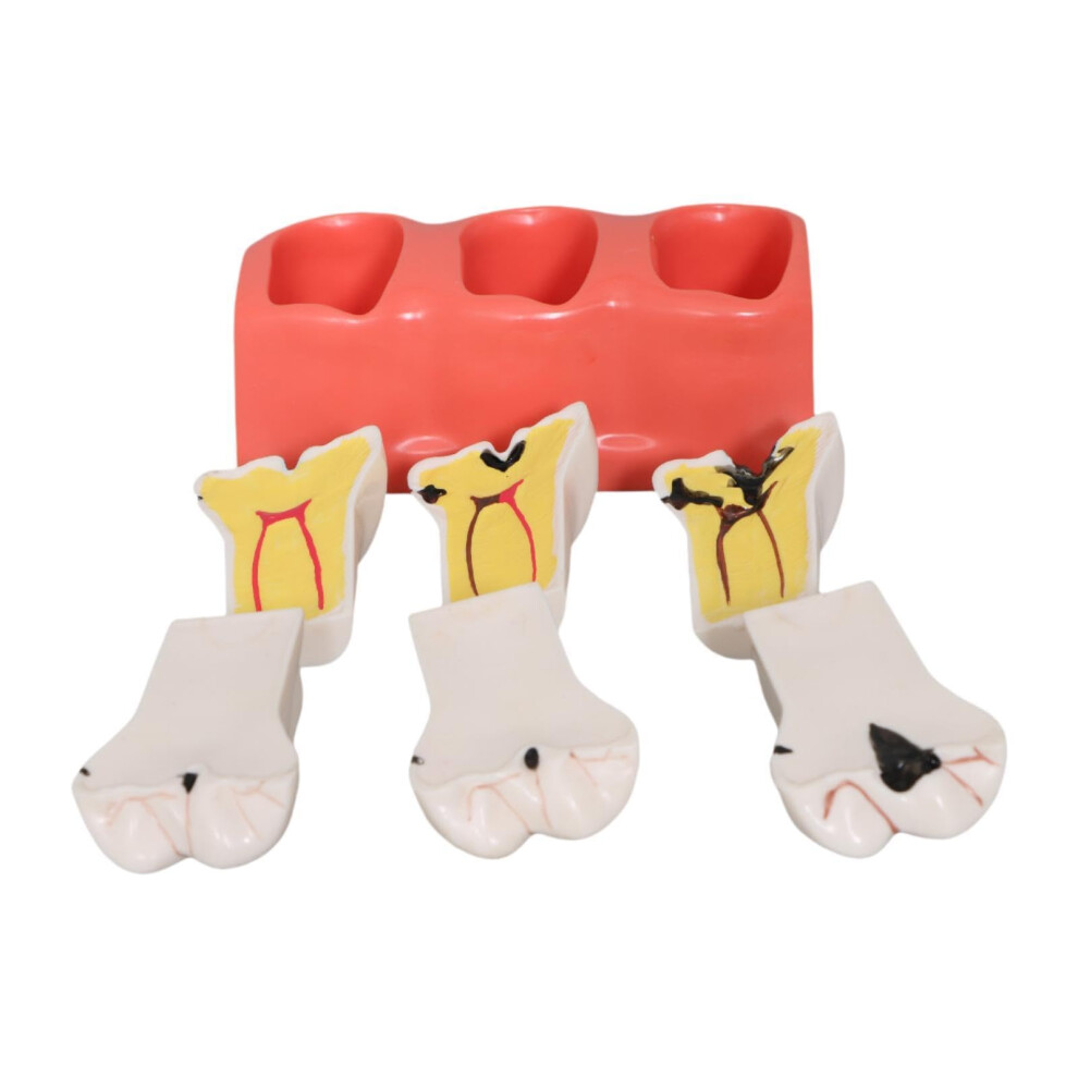 Decay tooth model demonstration training tooth model for care education