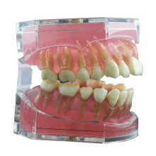 Dental implant dental model with soft gums and removable resin teeth for practice and teaching.