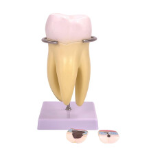 Dental Model Pathology Molar Anatomy for Dentist Patient Education
