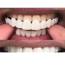 (The Baby Tooth Under)New Snap On Smile Dental False Teeth Cover Perfect Smile Veneers Comfort Fit Flex Denture Teeth - Niubi-csn