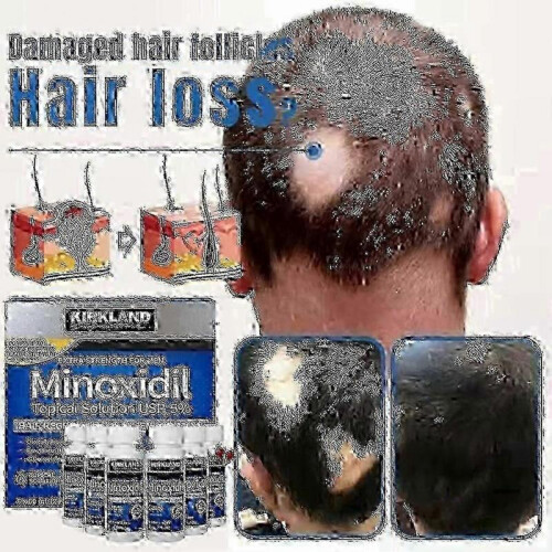 5 Extra Strength Men Hair Regrowth Solution Retail Box 2