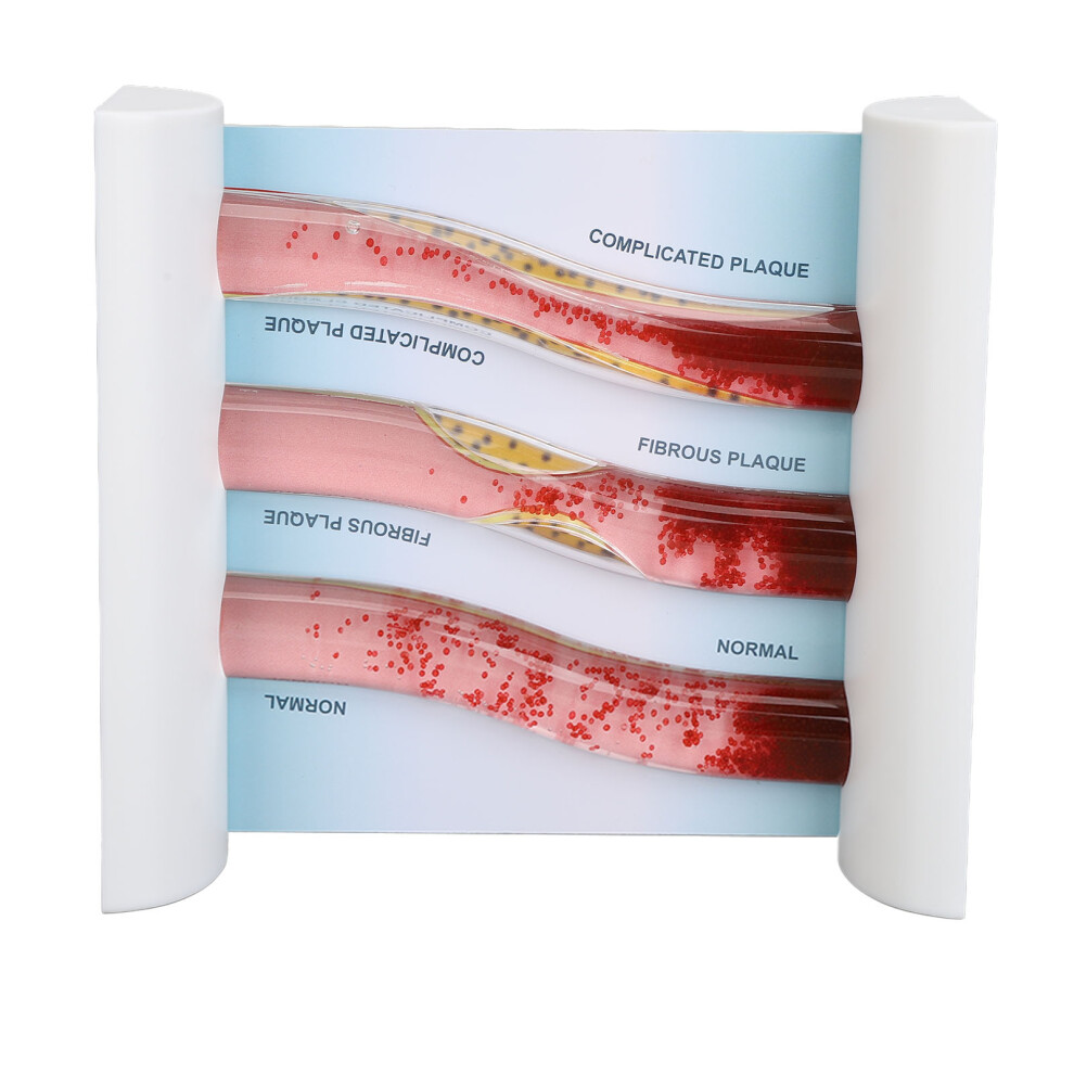 Lipoprotein LDL Blood Vessel Model for Teaching 15cm Low Density Lipid