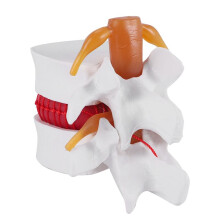 1:1.5 Human Lumbar Disc Herniation Demonstration Model of Lumbar Vertebral Spine Model for Human Anatomy
