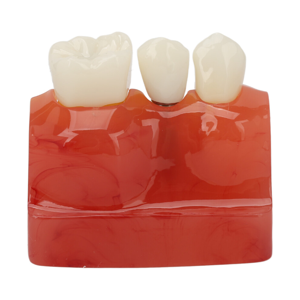 Dental Implant Demonstration Model, Resin Material With Detachable Preparation, Magnetic Design For Enhanced Stability, Lightweight And Durable, Perf