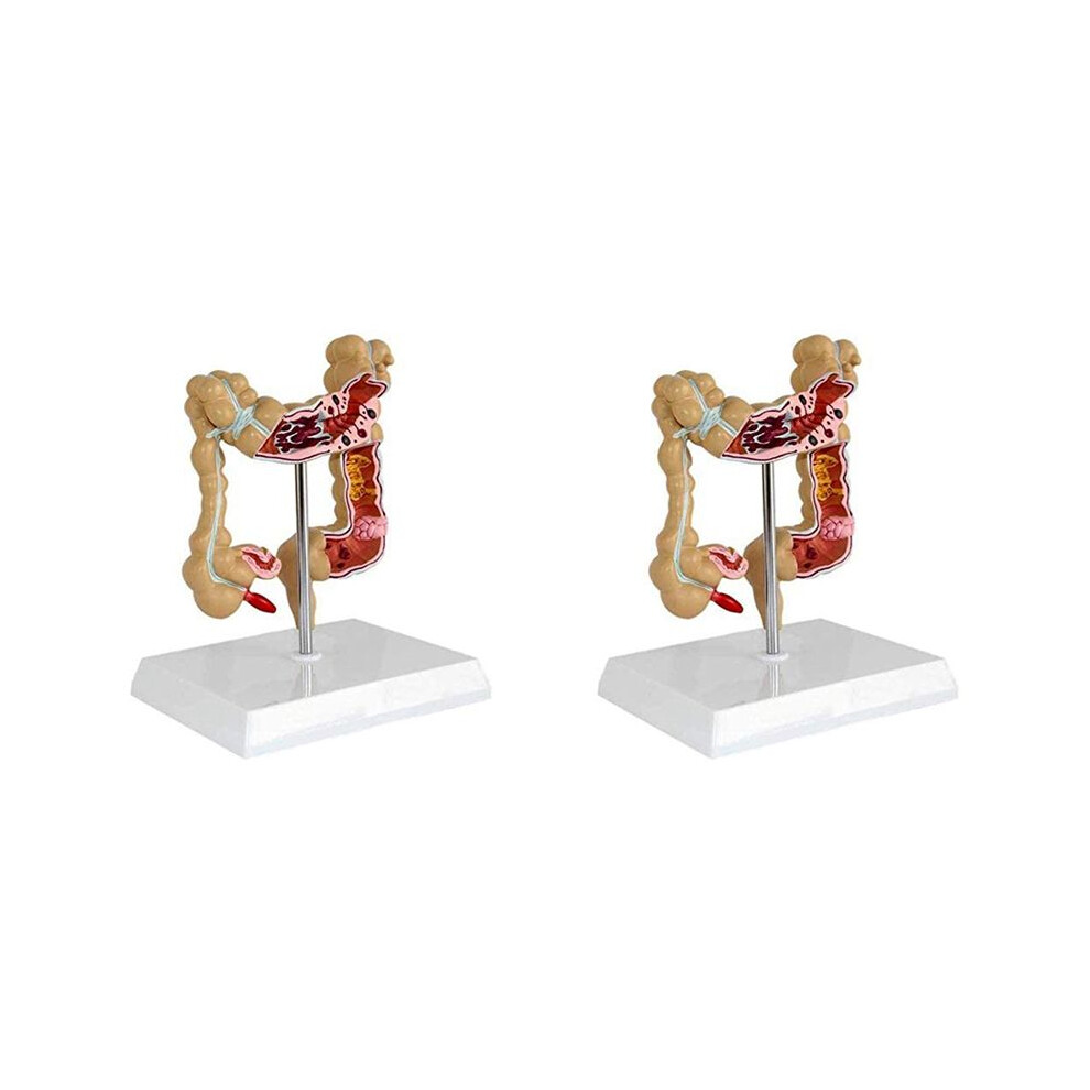 Unisex 2X Colon Pathological Colorectal Cancer Model Large Intestine Model Gastrointestinal Anatomical Model