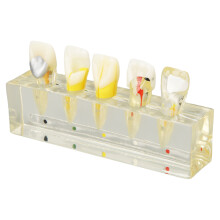 Modèle pédagogique d'endodontie : base en acrylique transparent illustrant l'impact de la carie dentaire sur la pulpe, démonstration de la mise